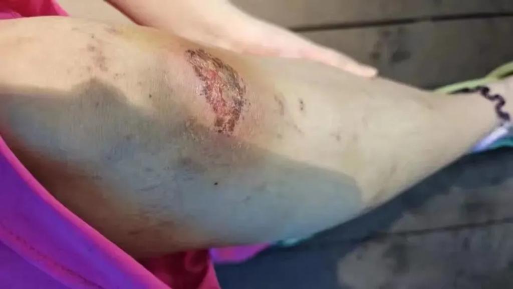 “美人鱼”女孩溺水进了ICU,危险的青春饭 第10张 “美人鱼”女孩溺水进了ICU,危险的青春饭 第10张
